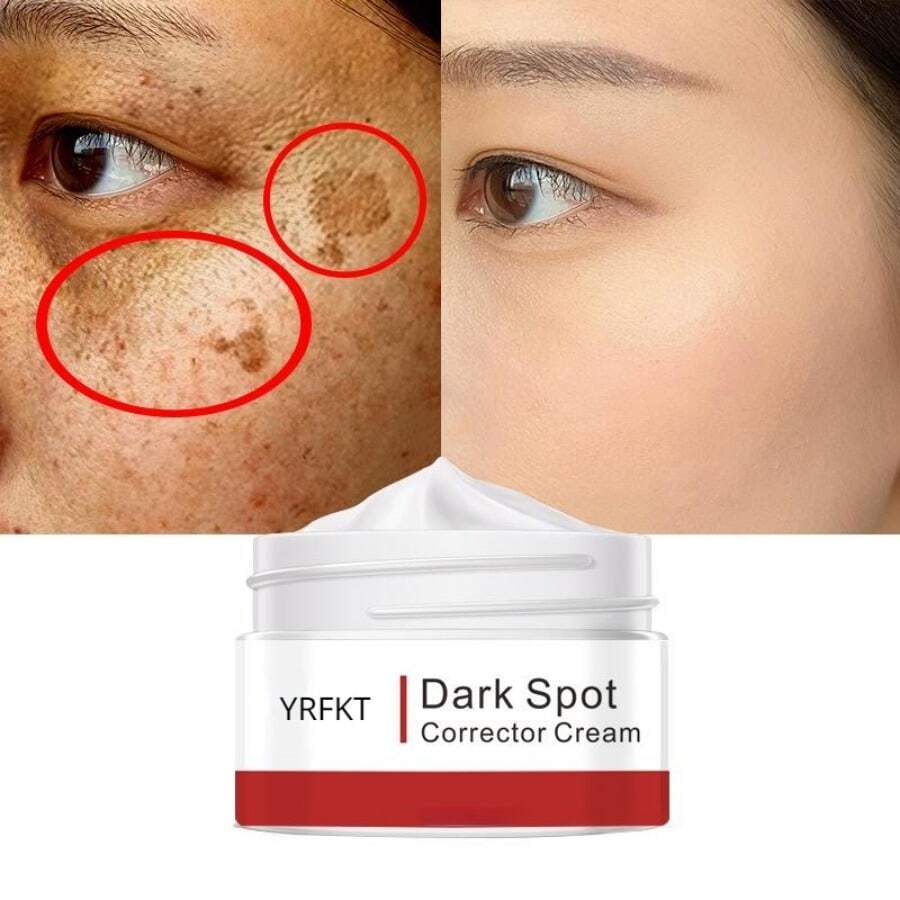 Effective Whitening Freckle Cream Remove Melasma Acne Spot Pigment Dark Spots Pigmentation Moisturizing Gel Skin Care